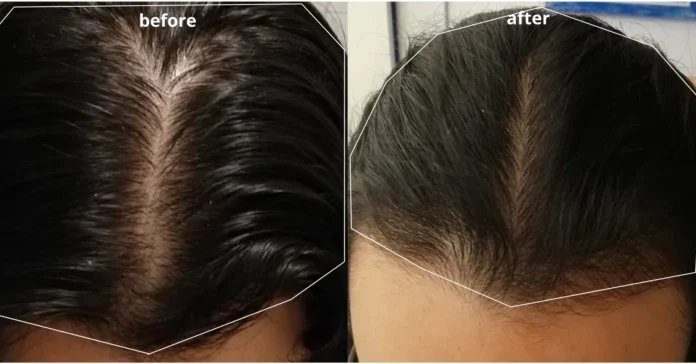 How do I grow hair thicker? Which vitamins can I take?